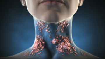 alekkks_Photorealistic_depiction_of_Thyroid_Disorders_showcasin_a4fb0515-4c3b-4d32-bf55-f5e0791d48d5